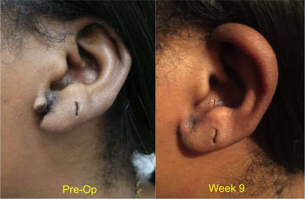 skin-surgery-photos-cyst-and-lipoma-removal-earlobe-repair