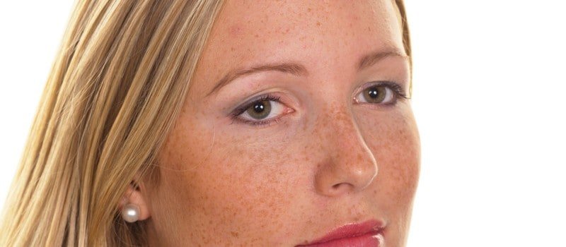 Hyperpigmentation / Melasma Clinic (Â£55) London | The GP 